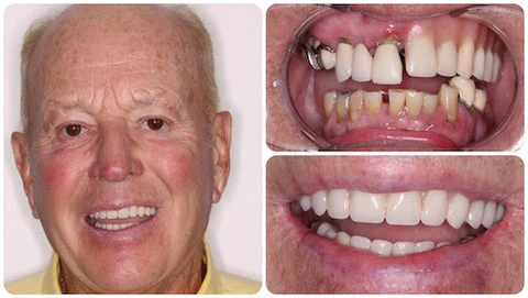 Biancat™ RadiantBrite Teeth Whitening Gel - Image 6