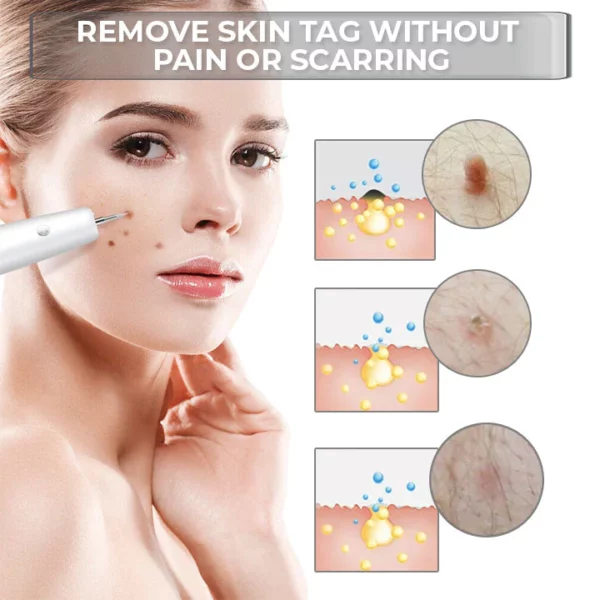 Fivfivgo™ Tragbarer Laser-Punktreinigungsstift - Image 8