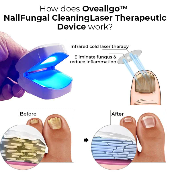 Oveallgo™ Dispositivo terapéutico con láser para limpieza de hongos y uñas - Image 4
