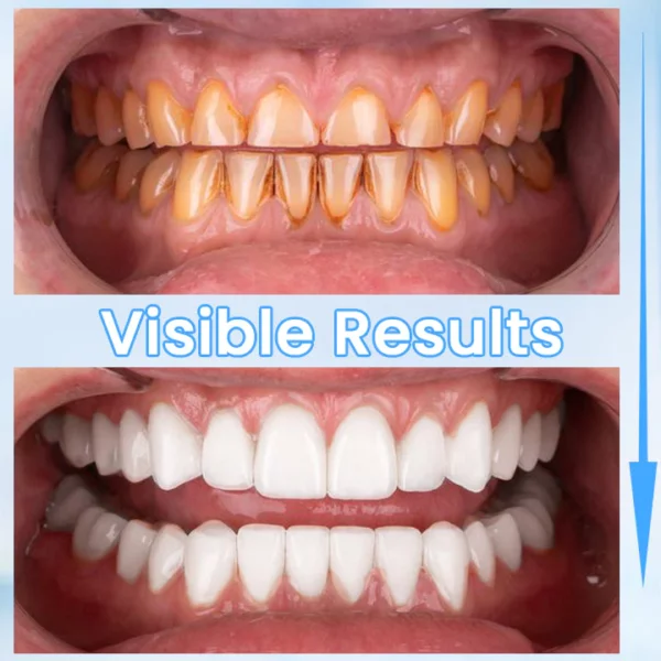 Ceoerty™ MedDent Teeth Whitening Repair Gel - Image 5