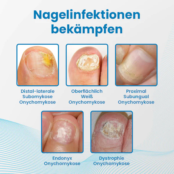 Ceoerty™ Anti-Paronychia Nagelbehandlungs-Gel - Image 7