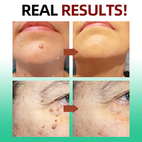 Fivfivg™ Tags & Muttermale Entferner Stift - Image 5