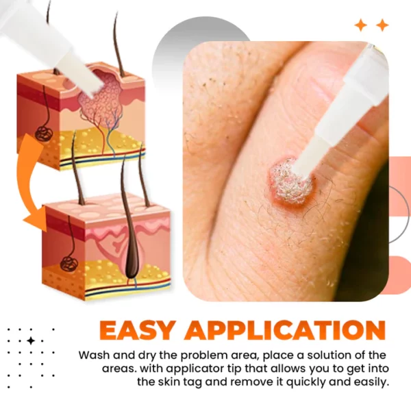 Zakdavi™️ Tags And Moles Remover - Image 4