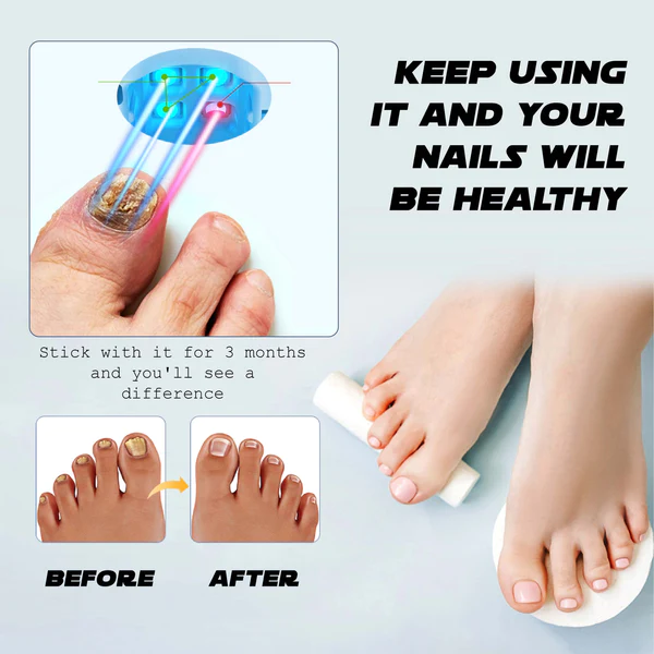 Oveallgo™ NailFungal CleaningLaser TherapeuticDevice - Image 8