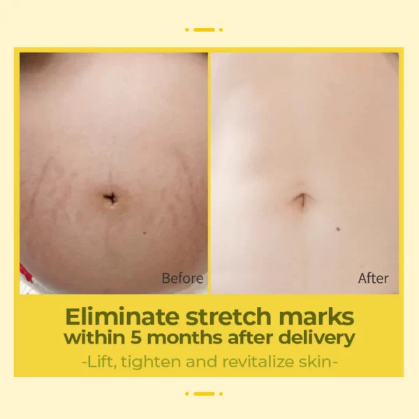 XRoland™ Olive Stretch Mark Treatment Oil - Image 5