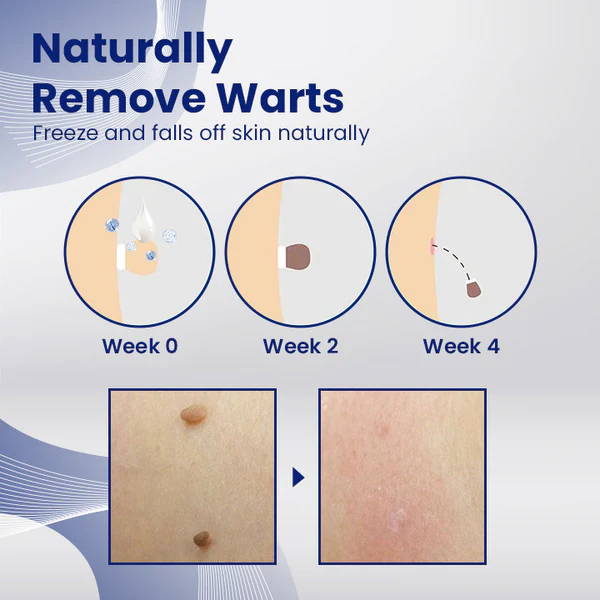 Ceoerty™ WartsErase Blemish Skin Remover Cream - Image 6