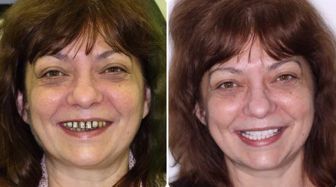 Biancat™ RadiantBrite Teeth Whitening Gel - Image 3