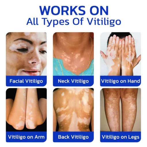GFOUK™ FastgoVitiligo Soothing Serum - Image 6