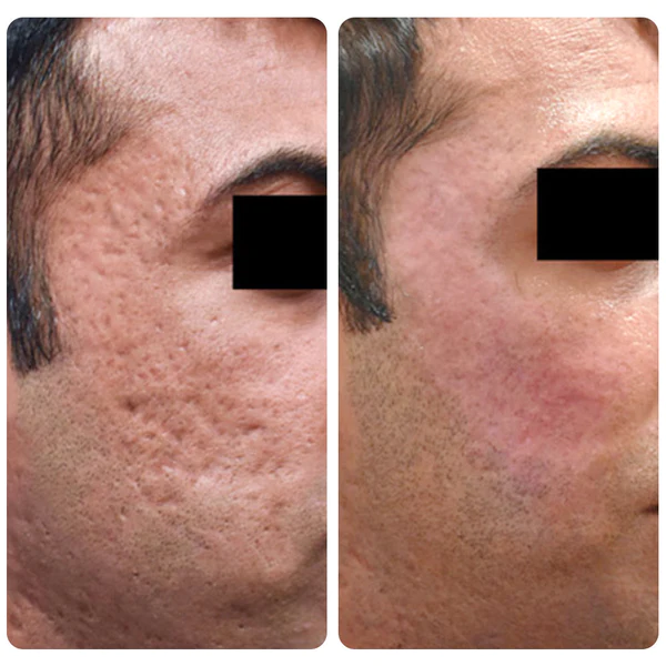 flysmus™ Dr.Treat PockennarbenHeilung Kollagen 0.5mm Dermaroller - Image 7