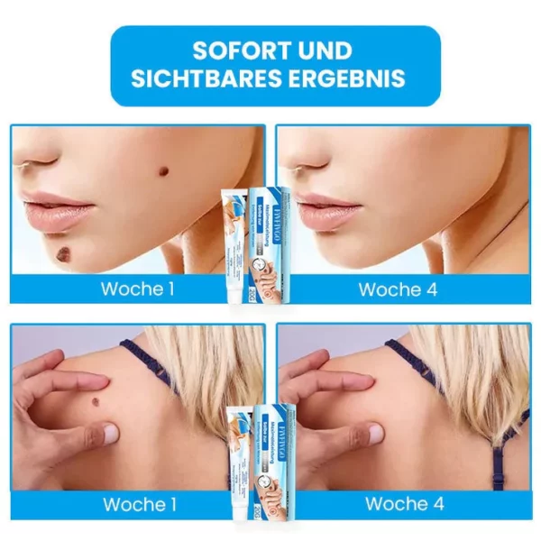 MaximaleLeistung Salbe zur sofortigen Entfernung von Warzen - Image 3