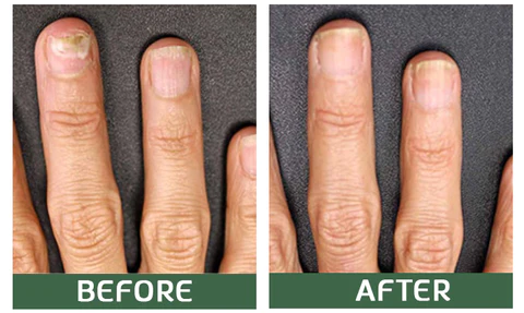 Furzero™ 5 Days Toenail Fungus Rapid Repair Pen - Image 5