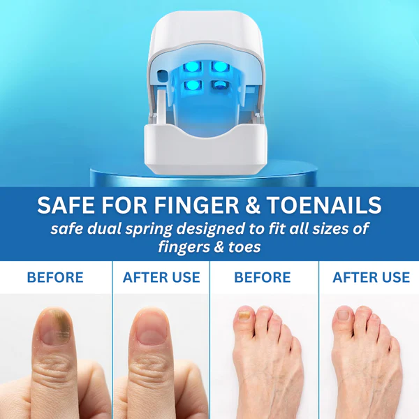 Pedimend™ Nail Fungus Laser Treatment Device - Image 6
