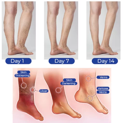 GFOUK™ VascuCare Vein Comfort Spray - Image 4