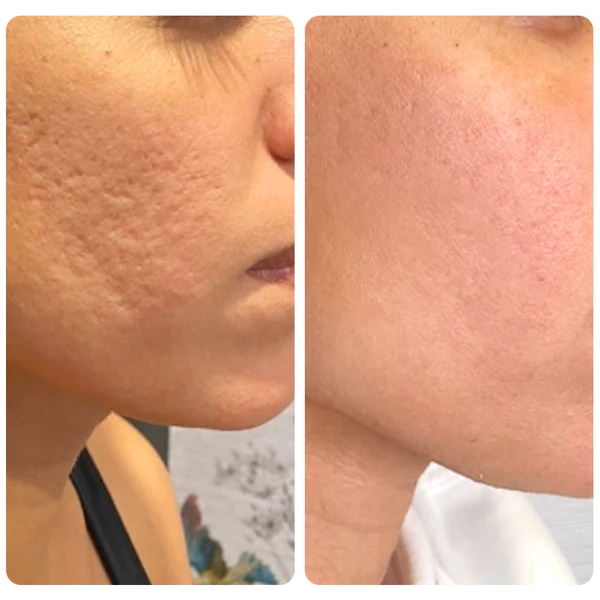 flysmus™ Dr.Treat PockennarbenHeilung Kollagen 0.5mm Dermaroller - Image 4