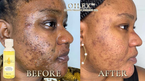 Ceoerty™ ClearSkin PROSpot Yellow Peeling Oil - Image 4