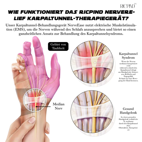RICPIND Nervenentlastung Karpaltunnel-Therapiegerät - Image 10