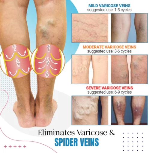 Raura™ Varicose Veins Treatment Spray - Image 3