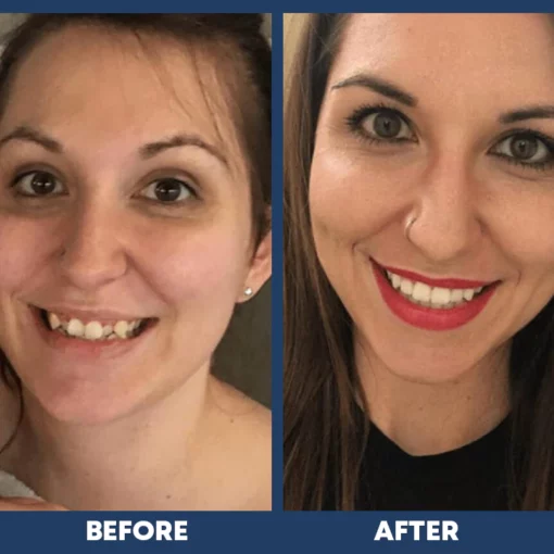 LIMETOW™ Dental Orthodontic Braces - Image 7