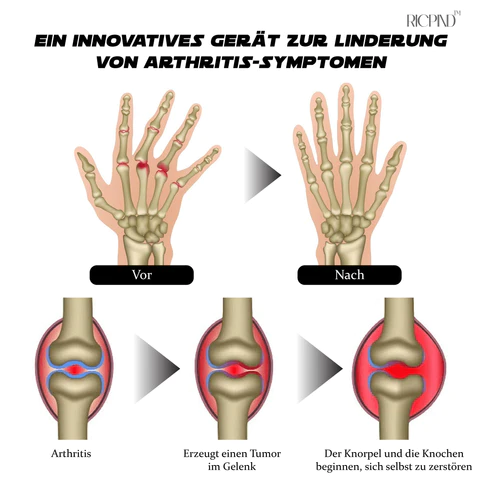 RICPIND Nervenentlastung Karpaltunnel-Therapiegerät - Image 6