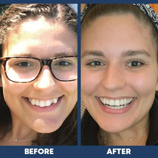 LIMETOW™ Dental Orthodontic Braces - Image 5