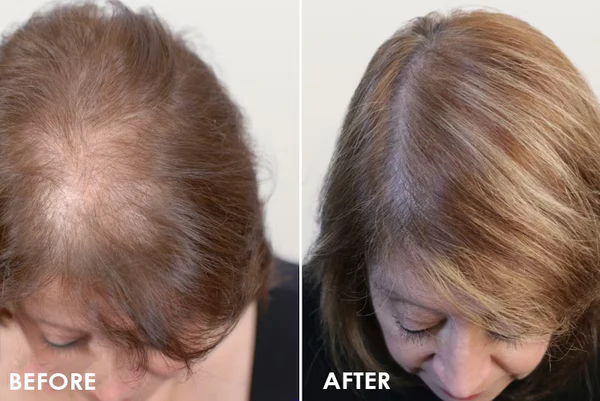 Sugoola™ Heiztherapie-Haarmaske zur Förderung des Haarwuchses - Image 9