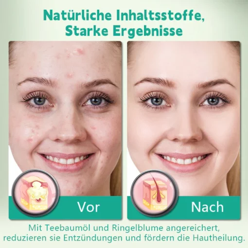 Biancat™ GentleCare Akne-Heilpflaster - Image 5