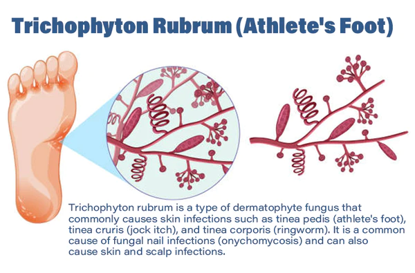 Furzero™ Medizinisches Nagelpilz-Fußspray - Image 10