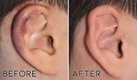 Fivfivgo™ DrWave Tinnitus NerveTreat Thermal Pen - Image 6