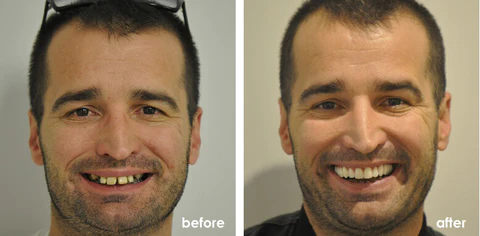 Oveallgo™ Shark Cartilage Protein Dental Regeneration Gel - Image 6