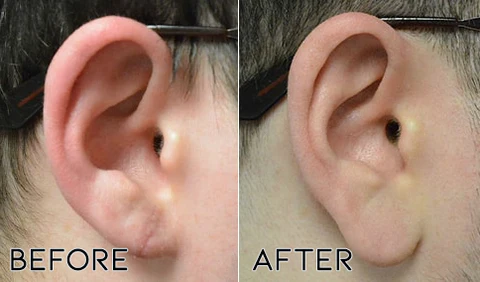 Fivfivgo™ DrWave Tinnitus NerveTreat Thermal Pen - Image 5