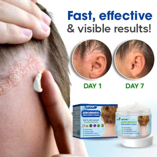 GFOUK™ Seborrheic Dermatitis Cream - Image 4