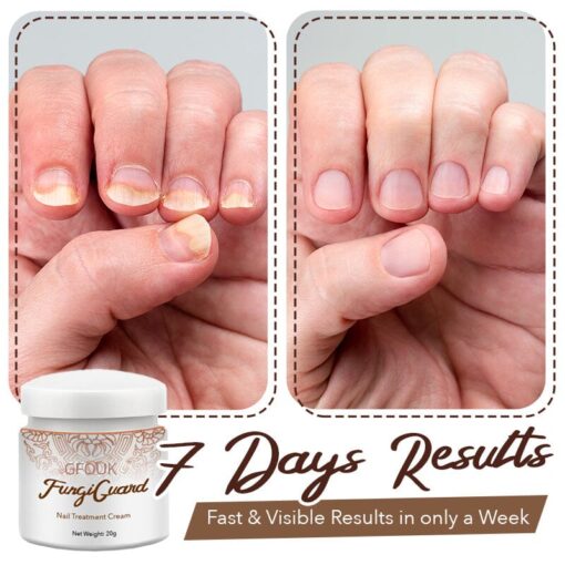 GFOUK™ FungiGuard Nail Treatment Cream - Image 5