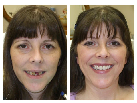 Unpree TEETH Mouthwash - Image 7