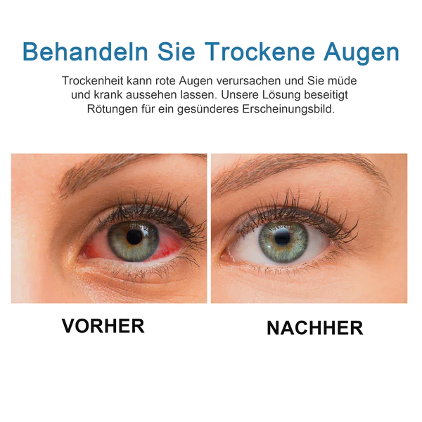 Ourlyard™ Augentropfen zur Behandlung von Sehproblemen - Image 5