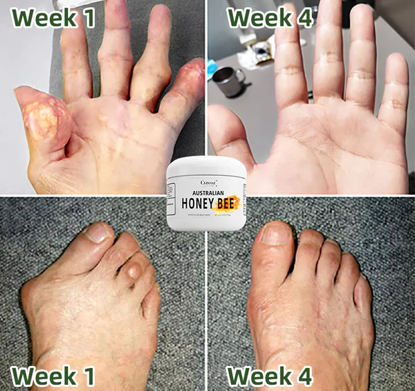 LIMETOW™ Australian honey bee Venom Pain and Bone Healing Cream - Image 3