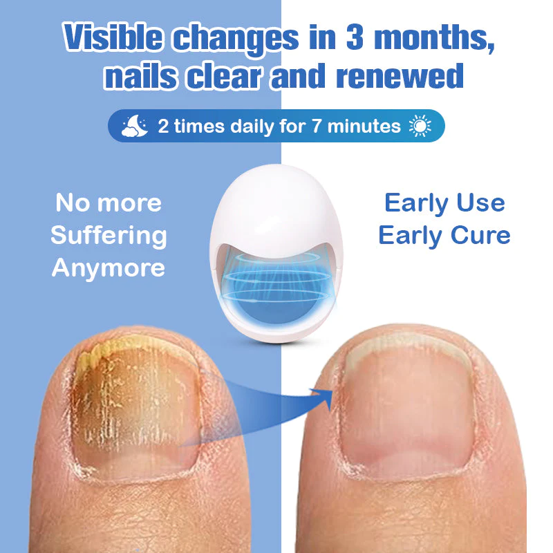 Furzero™ Nail Fungus Cleaning Laser Relief Device - Image 6
