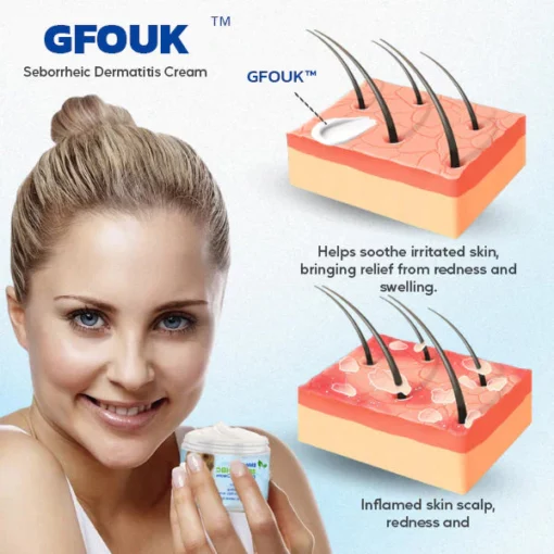 GFOUK™ Seborrheic Dermatitis Cream - Image 3
