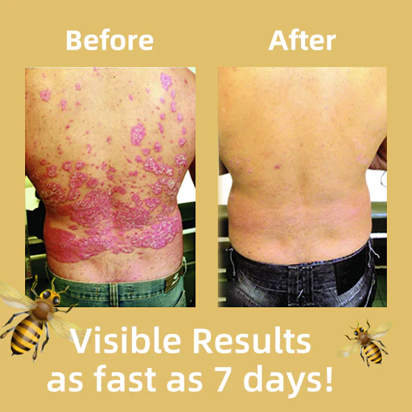 Lotmay™ Bee Venom Psoriasis Treatment Cream - Image 8