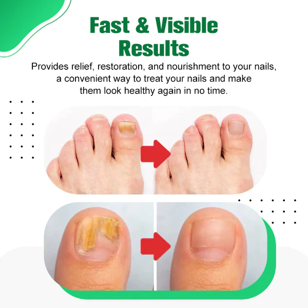 HerbNail™ Toenail Fungus Care Antibacterial Solution - Image 4