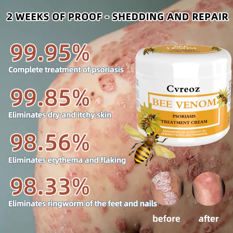 Lotmay™ Bee Venom Psoriasis Treatment Cream - Image 5