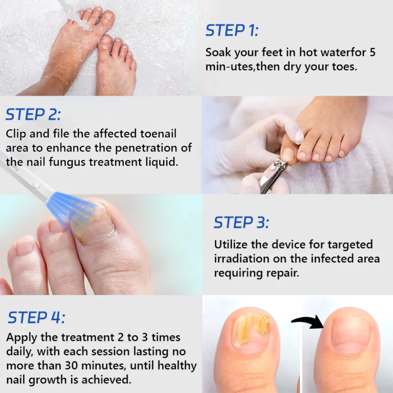 Furzero™ Toenail Fungus Laser Treatment Devices - Image 7