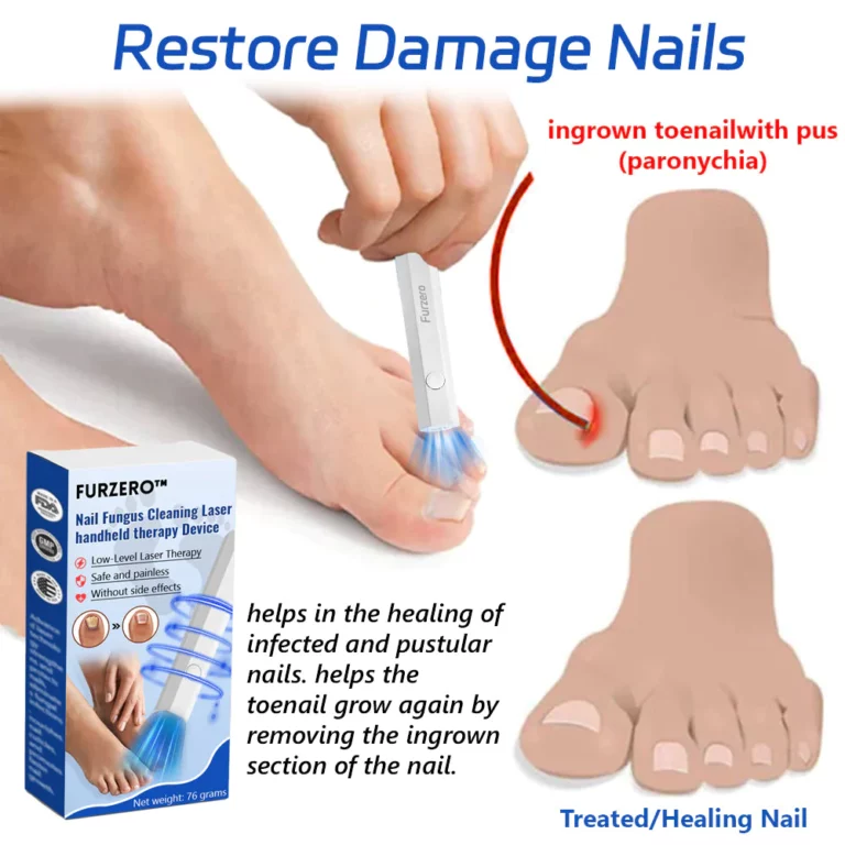 Furzero™ Toenail Fungus Laser Treatment Devices - Image 4