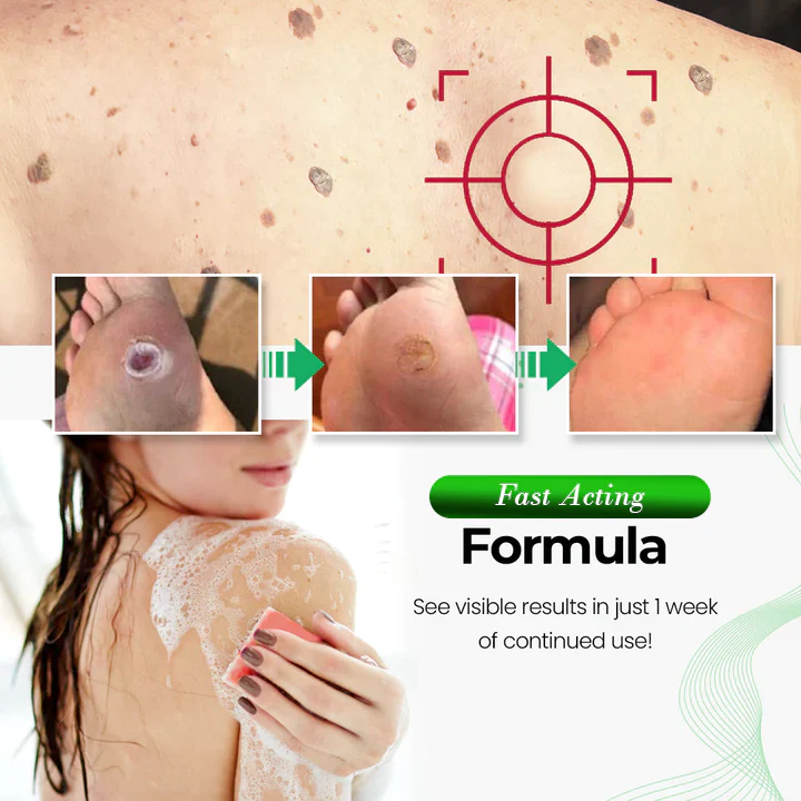 Fivfivgo™ WartWipeout Seife - Image 5