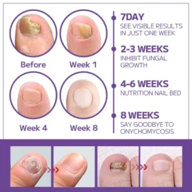 Furzero™Anti-fungal Nail Spray - Image 3