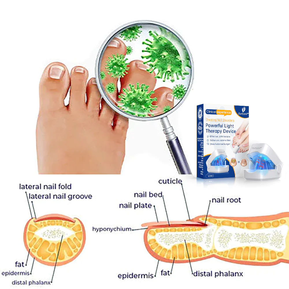 Ourlyard™ Powerful Light Therapy Device for Treating Nail Disorders - Image 6