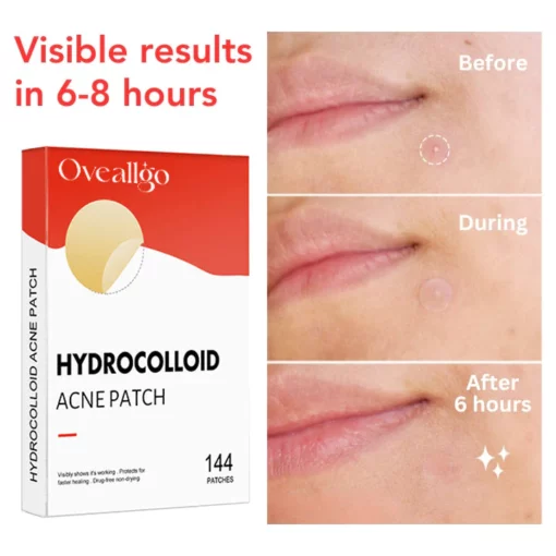 Oveallgo™ Nighttime Acne Patch - Image 2