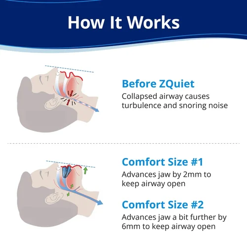 ZQuiet™ Anti Snore Mouthpiece - Image 6