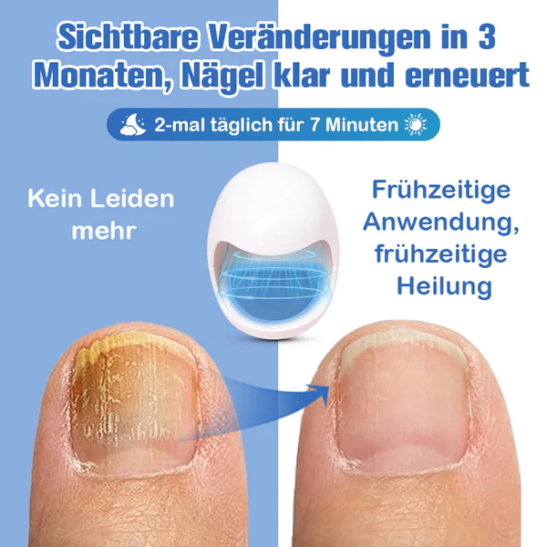 Furzero™ Nagelpilzreinigung Laser Linderungsgerät - Image 10