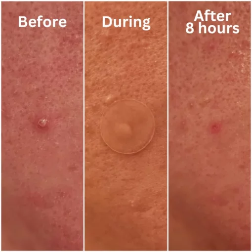 Oveallgo™ Nighttime Acne Patch - Image 5