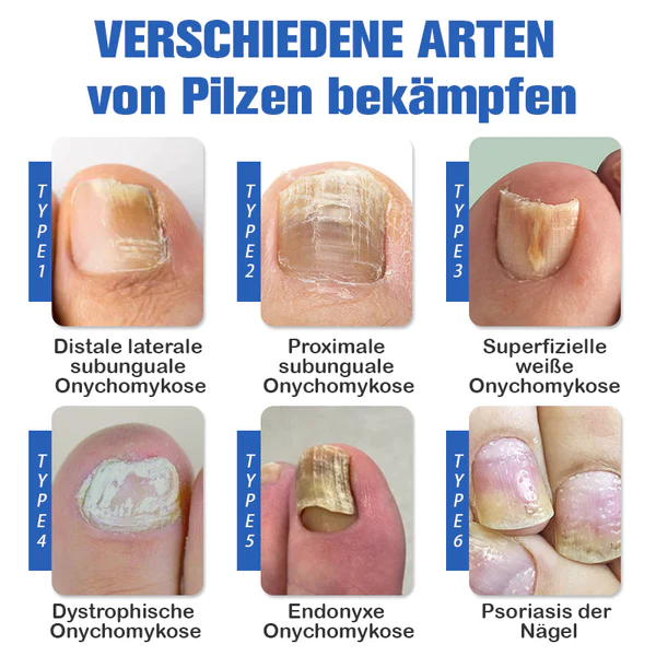 Furzero™ Nagelpilzreinigung Laser Linderungsgerät - Image 4